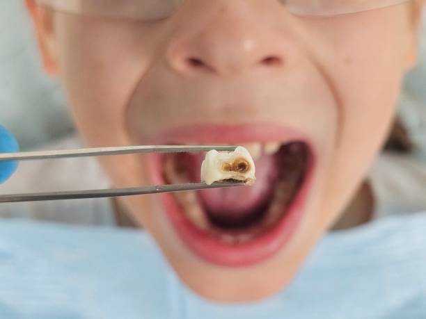 Best Emergency Wisdom Teeth Removal in Eau Claire, WI
